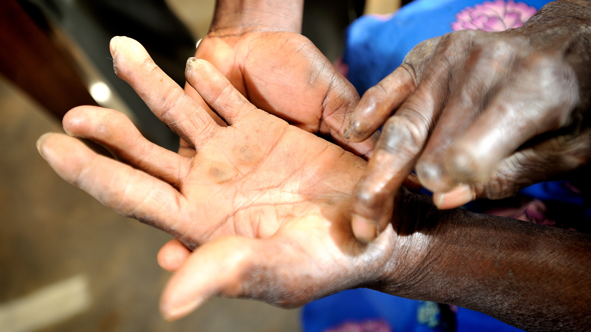 Eine alte Lepra-Patientin zeigt ihre Hände bei der Sprechstunde in der Lepra-Klinik. | picture alliance / Yannick Tylle